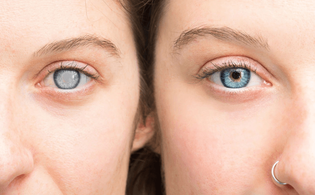Comparison of woman with cataract on the left and healthy eyes on the right