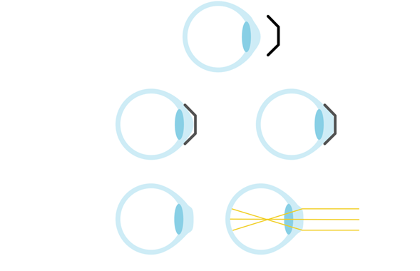 Diagram showing how ortho k lenses change the shape of the cornea