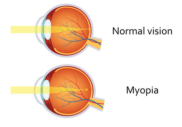 eye structures showing normal vision verses myopia