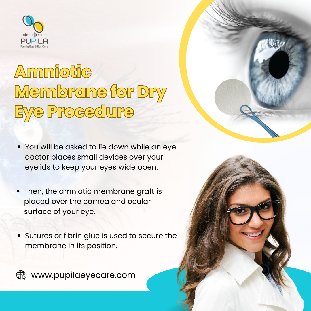 Amniotic Membrane for Dry Eye Procedure