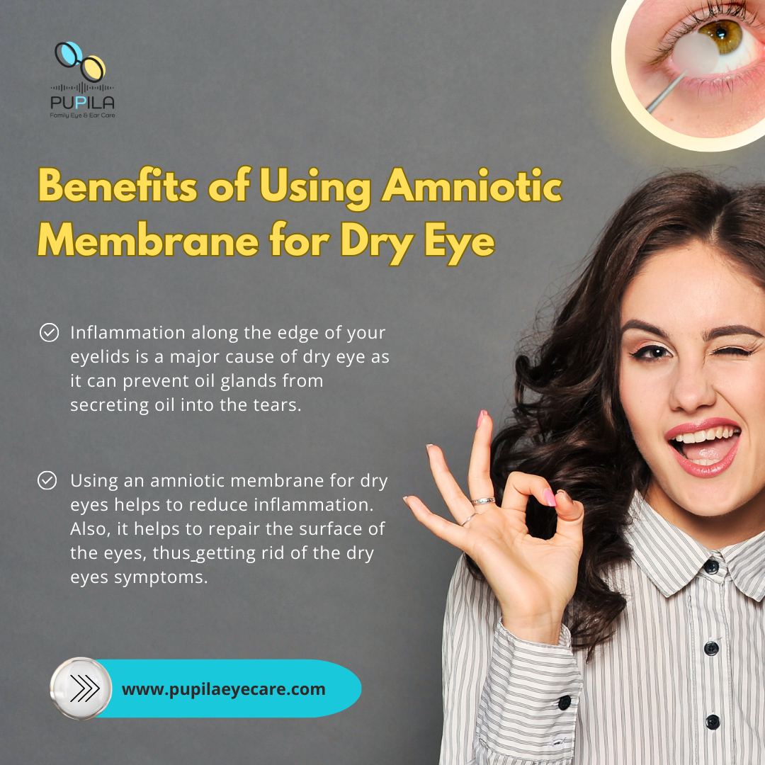 Benefits of Using Amniotic Membrane for Dry Eye 