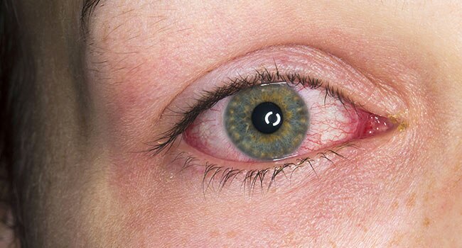 Markham Optometrist inflammed eye
