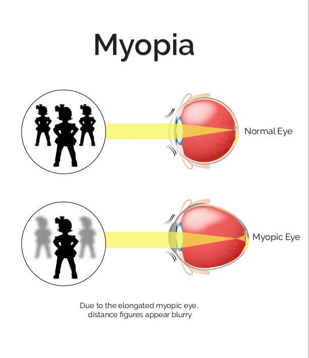 myopia diagram