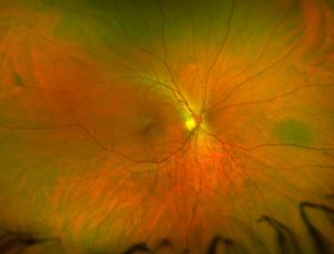 Optomap retina pic