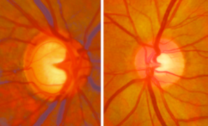Glaucoma retinal image 1