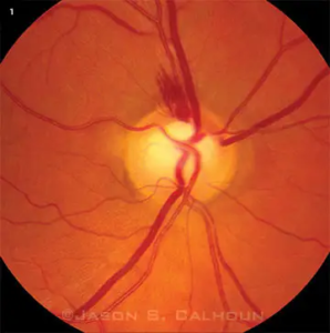 Glaucoma retinal image 2