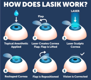How Does Lasik Work graphic