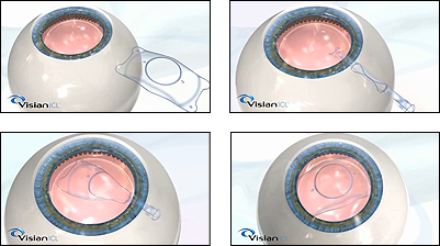 Lens implant graphic