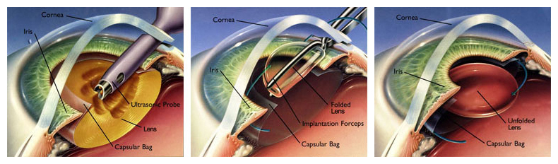 RLE surgery graphic