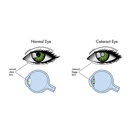 cataract eye crossection.png