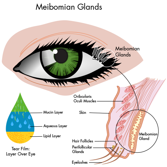 What Is Meibomian Gland Dysfunction