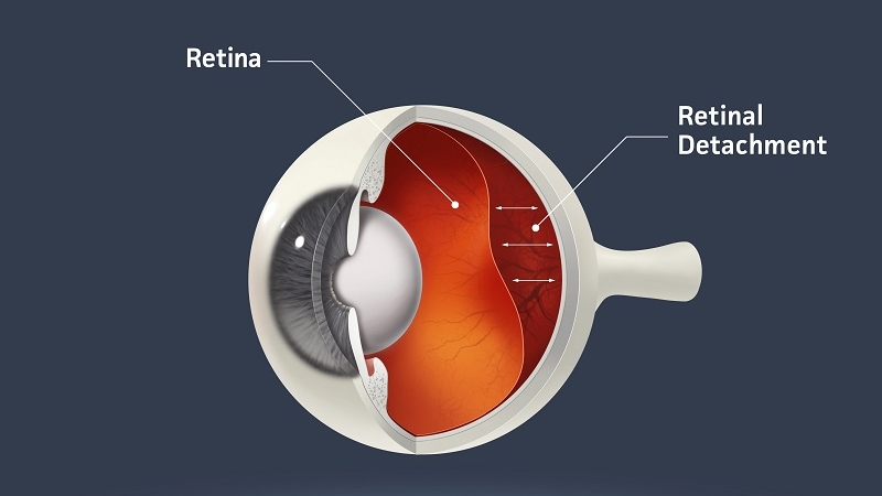 Retinal detachment graphic 16×9