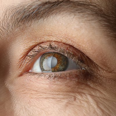 close up of cataract
