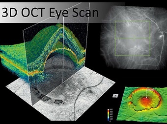 3D OCT eye scan