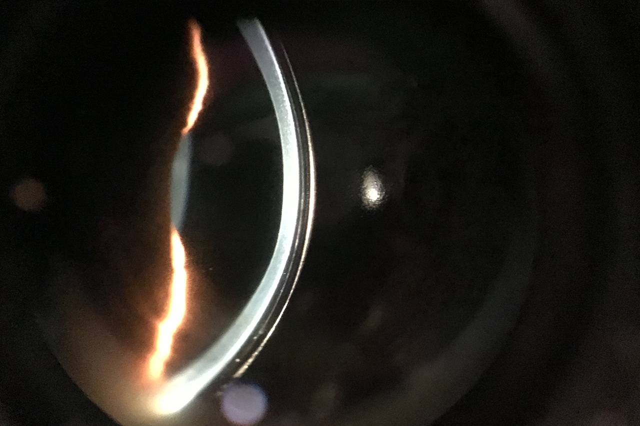 Cornea With Scleral Lens 1280×853