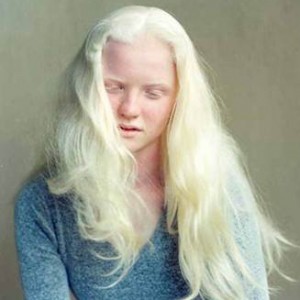 albinism 002 300×300