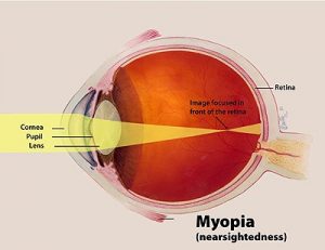 Myopia 300×231