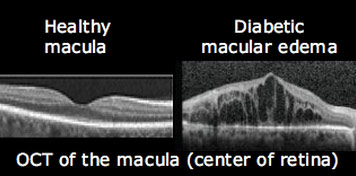 Diabetic macular edema