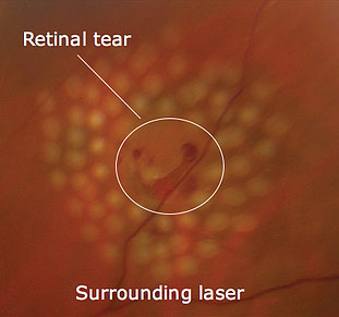Laser surrounding retinal tear