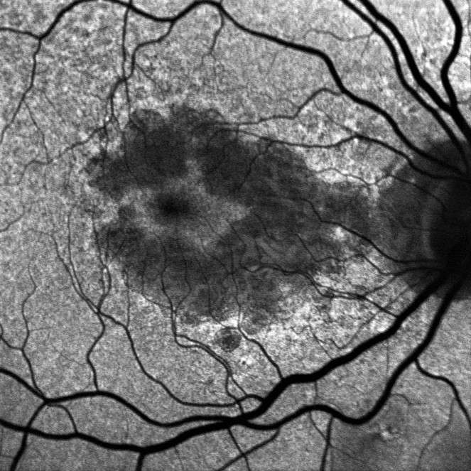 DRY AMD FOVEAL SPARING