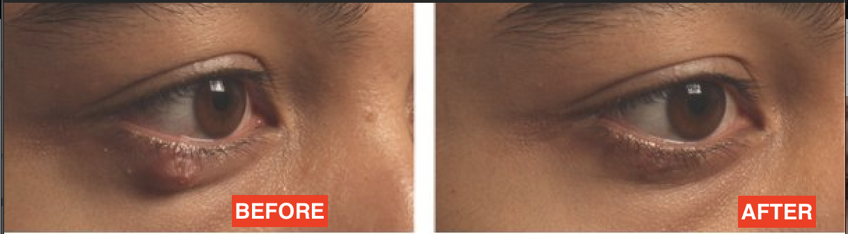 chalazion before and after