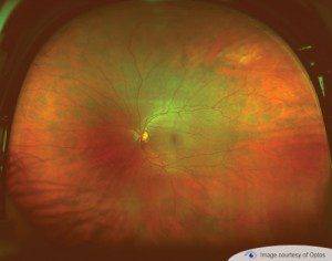optomap eye exam Alafaya FL