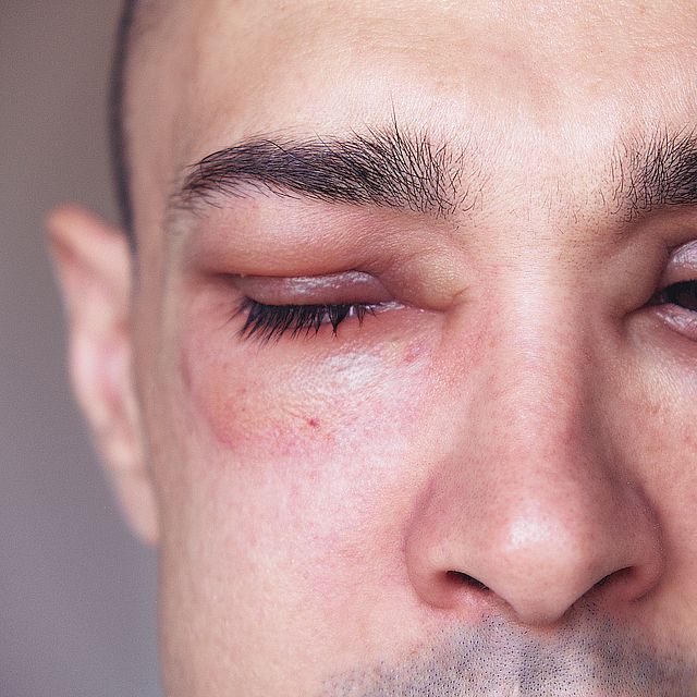 man with eye infection in both eyes