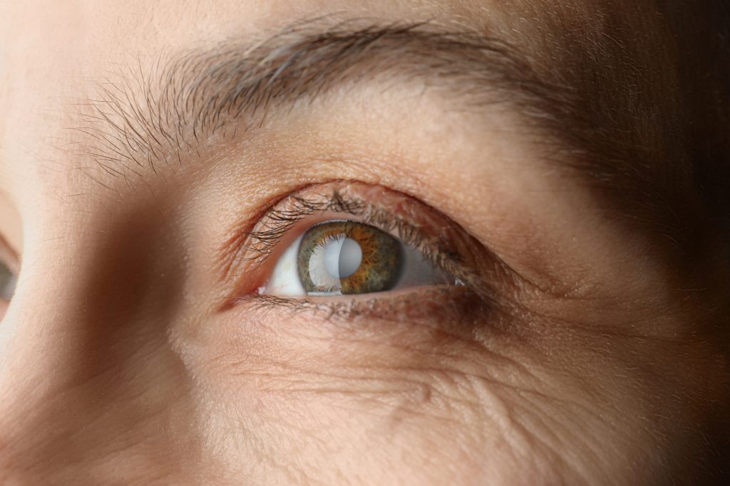 closeup view woman with cataract