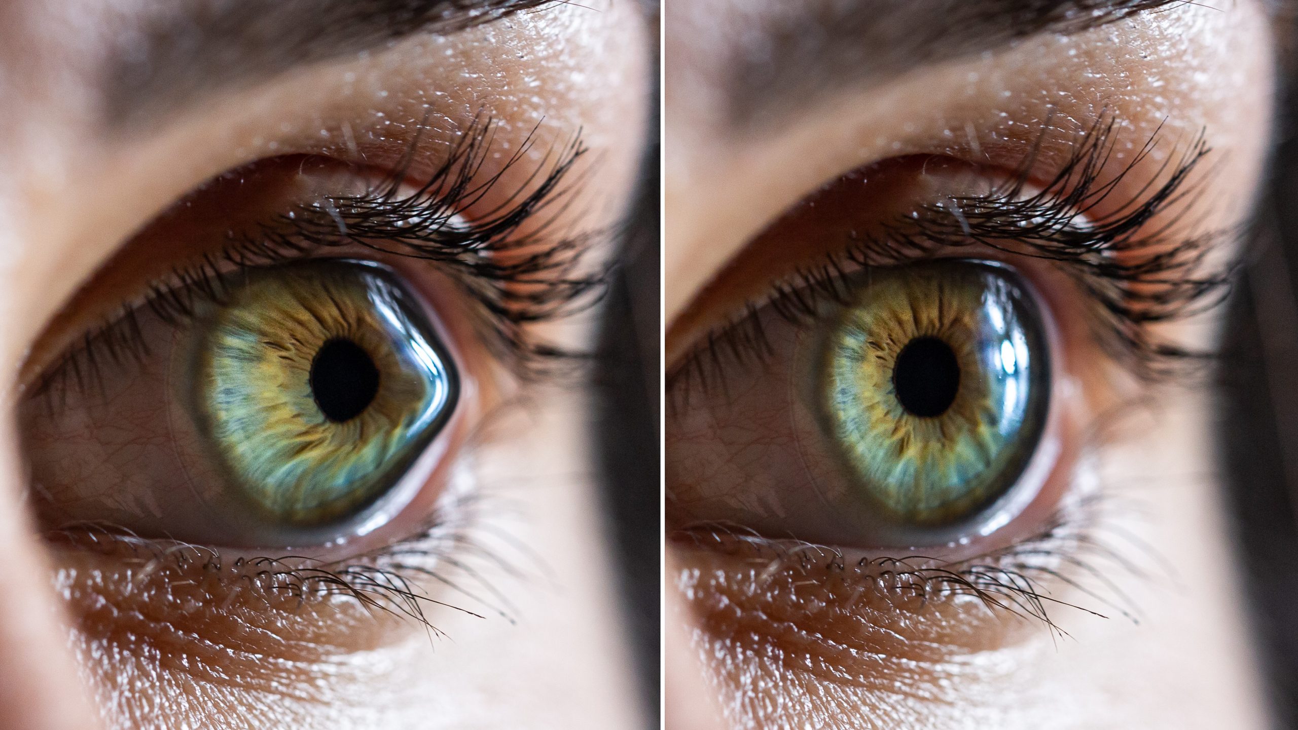 Macro of a clear female eye with keratoconus before and after surgery