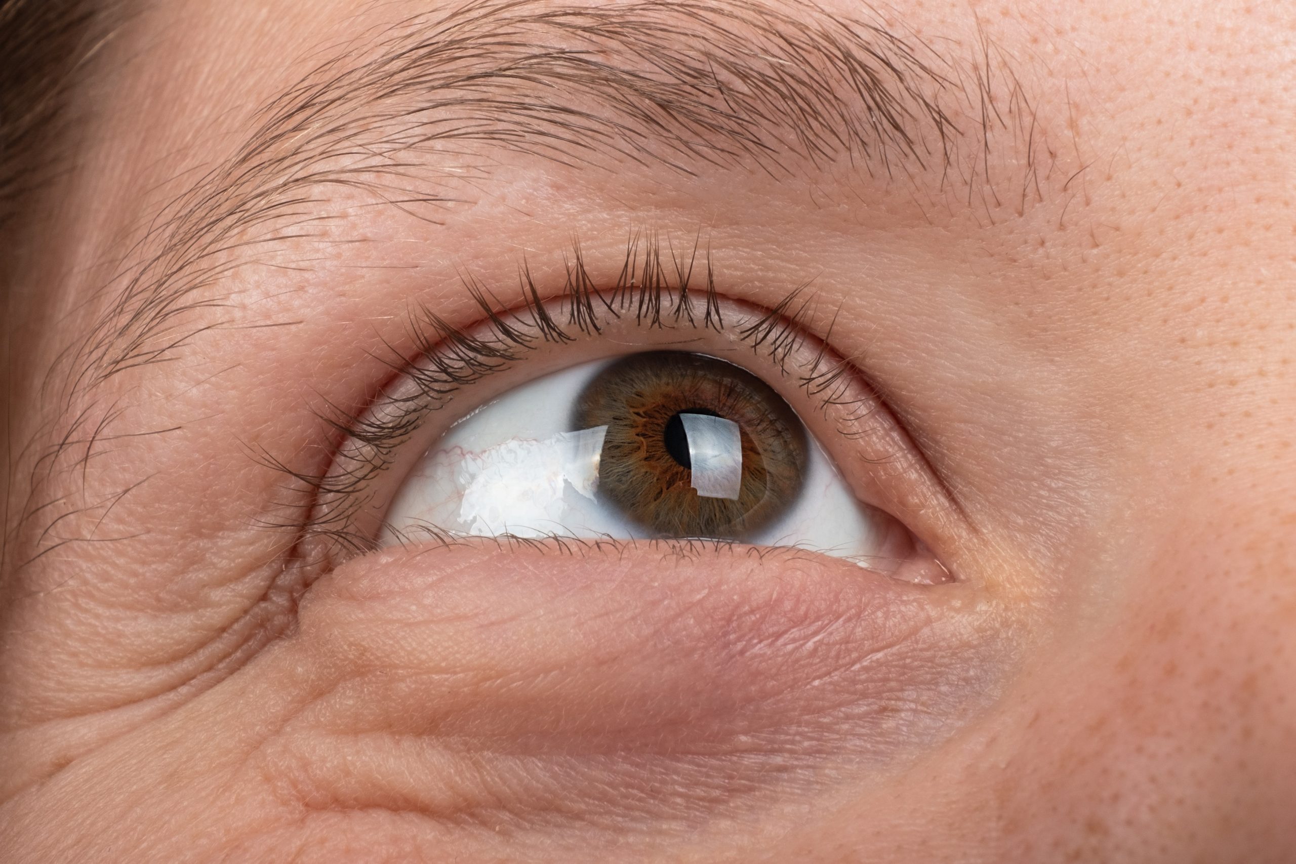 keratoconus disease of the cornea of the eye macro, fatigue corneal thinning