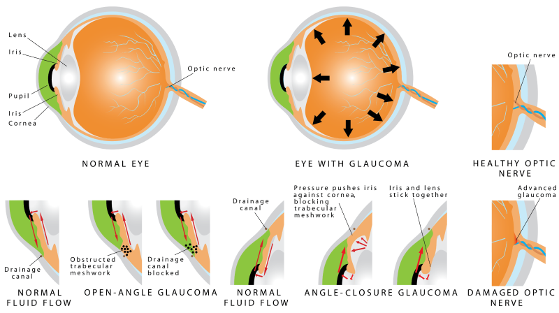 Glaucoma Graphics Desktop