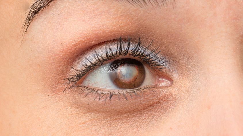 womans cataract up close