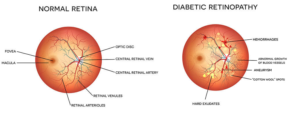 diabetic retinopathy chart
