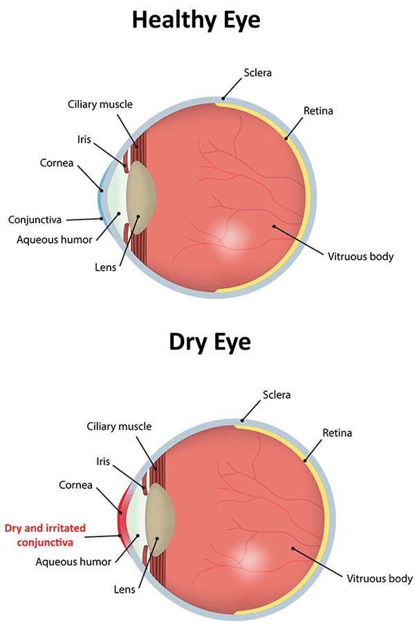 dry eye chart 1
