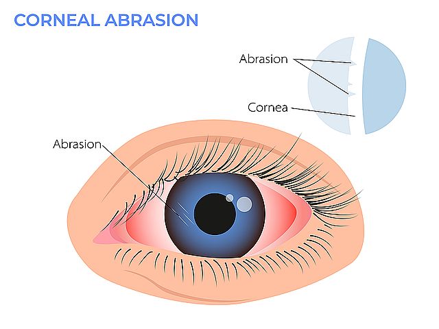 Corneal abrasion illustration. Eye redness symptom. pink red surfers eye