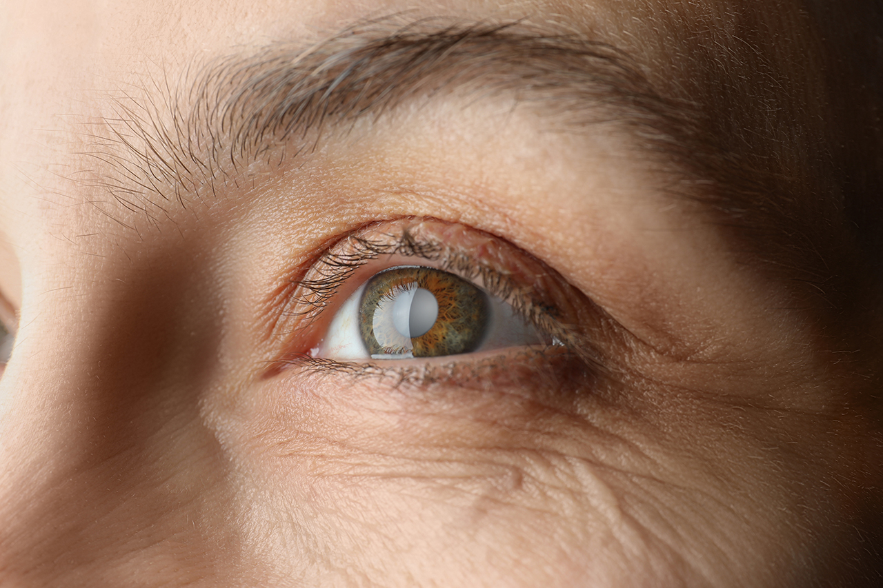 close-up-of-glaucoma-eye