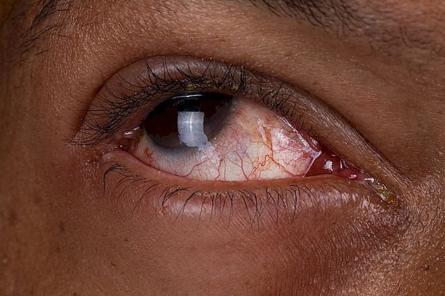 An infected eye with conjunctivitis or pink eye