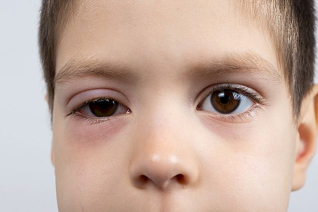 Eye of a child with conjunctivitis, inflammation of the conjunctiva, close up.