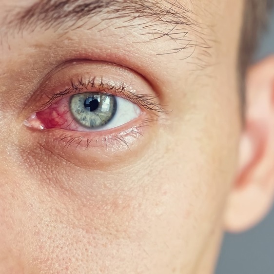 Close up of the red eye of a man affected by an infection