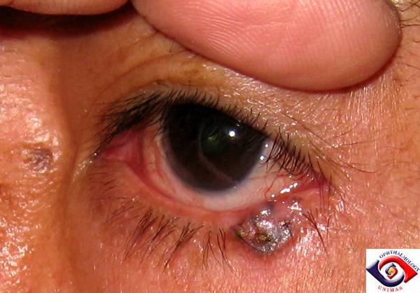 Basal Cell Carcinoma Eyelid