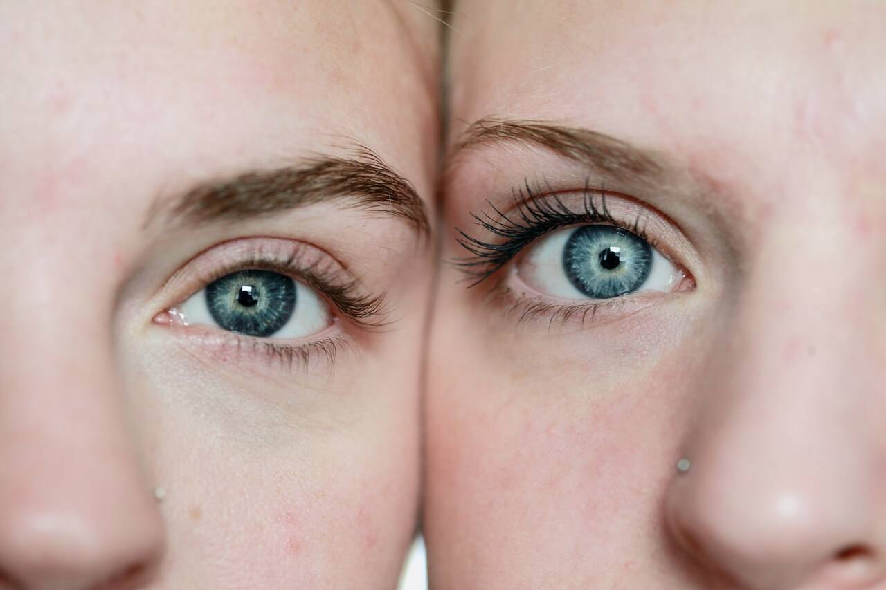 Close up of women's eyes, with Amblyopia