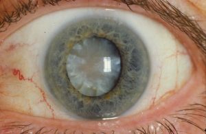 cataract example