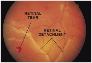 retinal tear detachment in Mississauga, Ontario