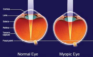 Normal Eye Vs. Myopic Eye, Kent, WA Ortho-K