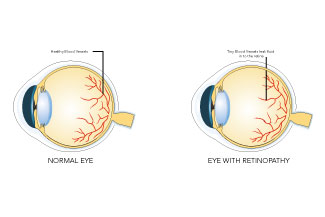 retinopathy thumb.jpg