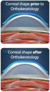 CRT image of cornea shaping rockville